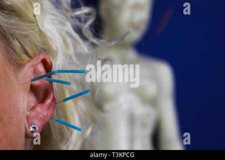 Près d'une oreille féminine avec aiguilles bleu : Ear acupuncture comme une forme de médecine alternative Banque D'Images