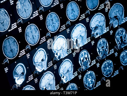 Irm de la tête et du cou, de la clinique du patient et d'info enlevé, tonique libre Banque D'Images