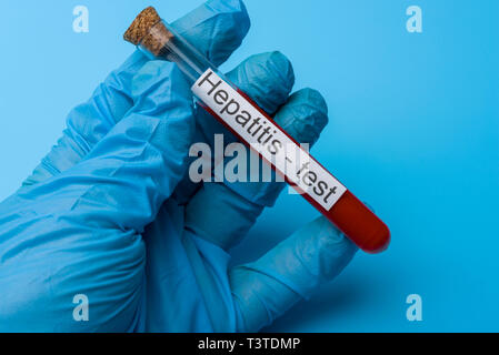 Test de l'hépatite, le sang dans le tube à essai. Le concept de la médecine et de l'analyse. Banque D'Images