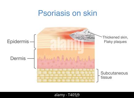 Illustration de la couche de peau humaine lorsque le psoriasis en plaques signes et symptômes apparaissent. Illustration de Vecteur