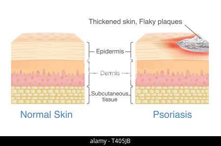 La couche de la peau normale et la peau lors de psoriasis en signes et symptômes apparaissent. illustration sur schéma de dermatologie. Illustration de Vecteur