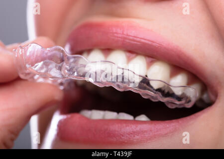 Close-up of a Woman's Hand Putting Alignement Transparent dans les dents Banque D'Images