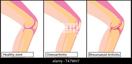 Types d'arthrite du genou et un genou sain vector illustration sur fond blanc Illustration de Vecteur