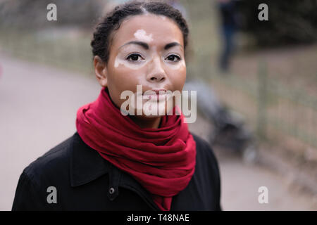 Une belle jeune fille d'origine ethnique africaine avec vitiligo debout sur le printemps chaud manteau noir habillé de la rue ville close up portrait of woman avec s Banque D'Images