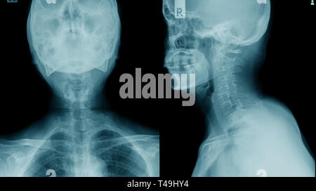 X-ray c-spine, la spondylose cervicale cas x-ray image Banque D'Images