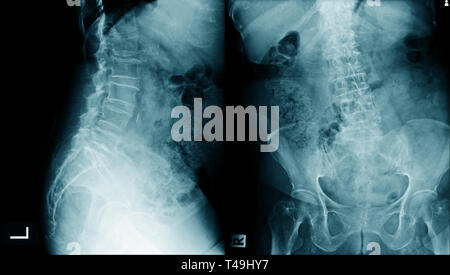 La spondylose lombaire x-ray image AP et vue latérale. Banque D'Images