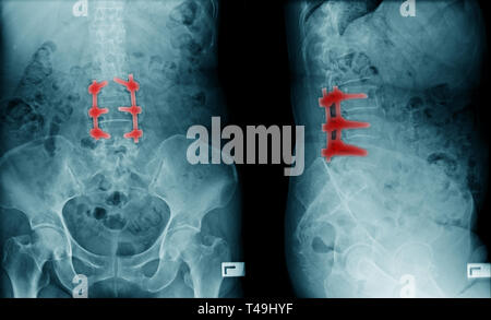 Compression lombaire avec la fixation interne de la fracture Banque D'Images