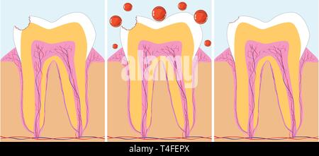 La phase trois de traitement des caries, vector illustration Illustration de Vecteur