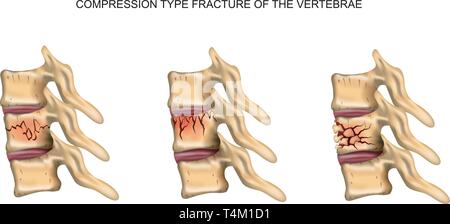 Vector illustration d'un type de compression fracture de la colonne vertébrale Illustration de Vecteur