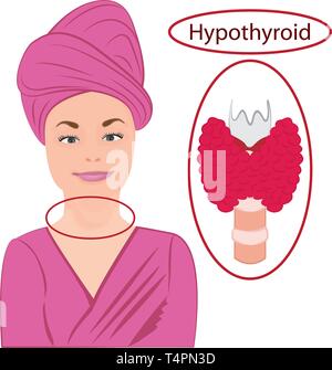 Le goitre. La thyroïde élargie. Dysfonctionnement endocrinien vector illustration sur fond blanc Illustration de Vecteur