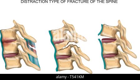 Vector illustration d'une distraction type de fracture de la colonne vertébrale Illustration de Vecteur