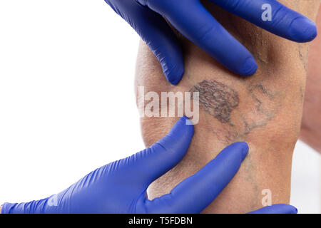 Infirmier de gants chirurgicaux en latex toucher varices de la jambe du patient isolé sur fond blanc studio Banque D'Images