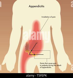 Illustration médicale montrant les points qui causent la douleur à la palpation lors de l'attaque de l'appendicite. Illustration de Vecteur