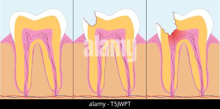 La phase trois de carie, vector illustration Illustration de Vecteur
