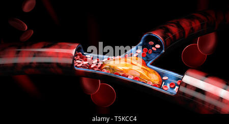 3d illustration de thrombose veineuse profonde ou embolie pulmonaire, caillots de sang Banque D'Images