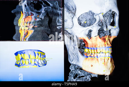 Et panoramique dentaire 3D x-ray de coups Banque D'Images