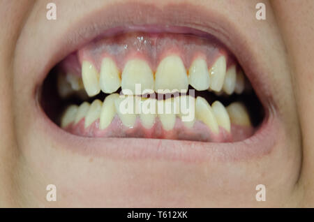 Gros plan de l'embouchure d'un fumeur homme avec les dents jaunes et le  tabac La nicotine, laides taches sur les dents Photo Stock