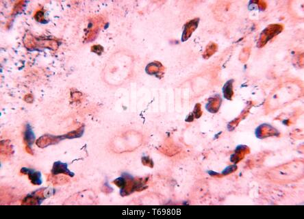 Une photomicrographie révélant Treponema carateum bactéries obtenues à partir d'un chimpanzé à l'aide d'Krajain teinté, 1970. Pinta est causée par Treponema carateum. Cette maladie se produit seulement dans les régions tropicales d'Amérique centrale et du Sud. Il est caractérisé par une papule indolore (primaire) suivi 2 - 18 mois plus tard par des papules secondaire sur les mains, les pieds et le cuir chevelu. Image courtoisie CDC. Banque D'Images