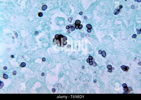 Methenamine tache argentée photomicrographie des changements histopathologiques dans l'histoplasmose causé par le champignon dimorphe Histoplasma capsulatum, 1972. Image courtoisie Centres for Disease Control and Prevention (CDC) / Dr Libero Ajello. () Banque D'Images