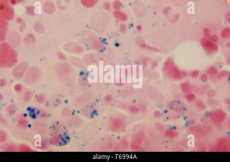 Une photomicrographie détecter la présence d'hémosidérine, teinté bleu, au sein de la moelle osseuse diffuse, 1972. Hémosidérine, révélé ici en utilisant le PAS tache et HandE counterstain, est un sous-produit normal produit au cours de la rupture des globules rouges, et de la décomposition de la molécule d'hémoglobine contenue dans ces composants sanguins. Image courtoisie CDC/Dr. Gordon D. McLaren. Banque D'Images