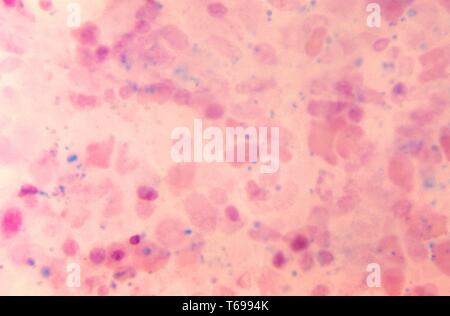 Une photomicrographie détecter la présence d'hémosidérine, teinté bleu, au sein de la moelle osseuse diffuse, 1972. Hémosidérine, révélé ici en utilisant le PAS tache et HandE counterstain, est un sous-produit normal produit au cours de la rupture des globules rouges, et de la décomposition de la molécule d'hémoglobine contenue dans ces composants sanguins. Image courtoisie CDC/Dr. Gordon D. McLaren. Banque D'Images