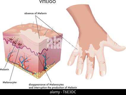 Illustration médicale des symptômes de vitiligo sur un côté Illustration de Vecteur