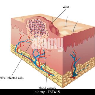 Illustration médicale d'une section d'une verrue Illustration de Vecteur