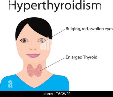 Le goitre. La thyroïde élargie. Dysfonctionnement endocrinien vector illustration sur un fond blanc. L'hyperthyroïdisme Illustration de Vecteur
