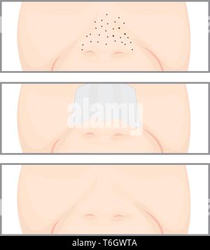 Les points noirs sur le nez vector illustration montrant les problèmes de peau Illustration de Vecteur