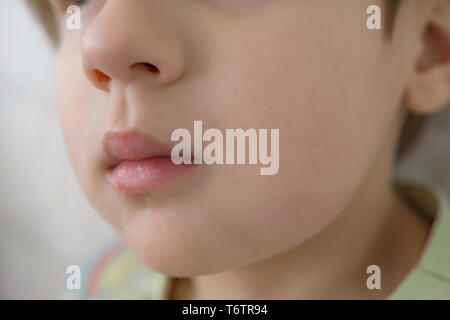 Close-up d'un enfant avec des dents, un gonflement des joues, la gangrène. Problèmes avec les dents de lait. Banque D'Images