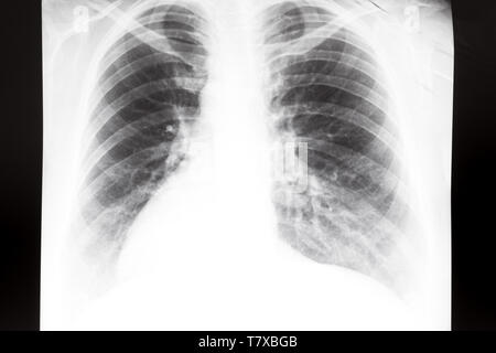 Vue avant du thorax humain avec poumons sur X-ray image Banque D'Images
