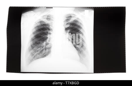 Film avec X-ray image de vue avant du thorax humain isolé sur fond blanc Banque D'Images