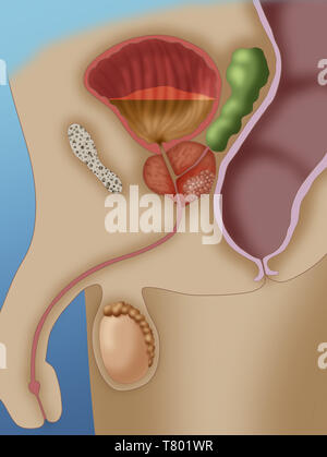 Le cancer de la prostate, illustration Banque D'Images