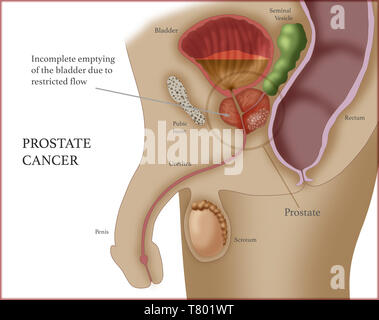 Le cancer de la prostate, illustration Banque D'Images