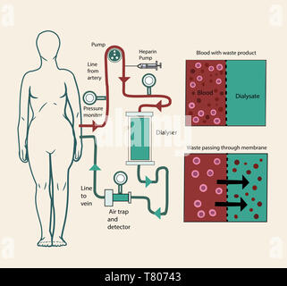 La dialyse, illustration Banque D'Images