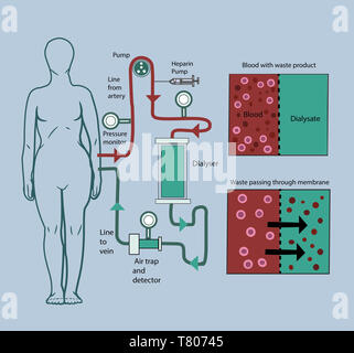 La dialyse, illustration Banque D'Images