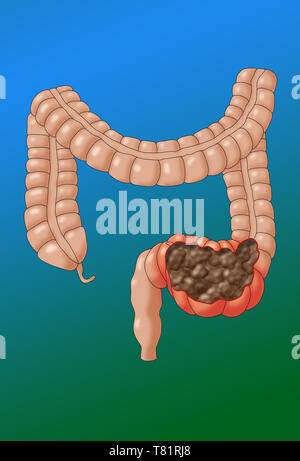 Côlon constipé, illustration Banque D'Images