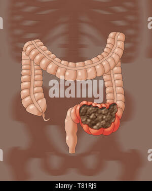 Côlon constipé, illustration Banque D'Images