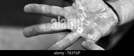 Palms avec durillons. Ampoules aux mains les blessés de travail manuel. Travail difficile Concept. Banque D'Images