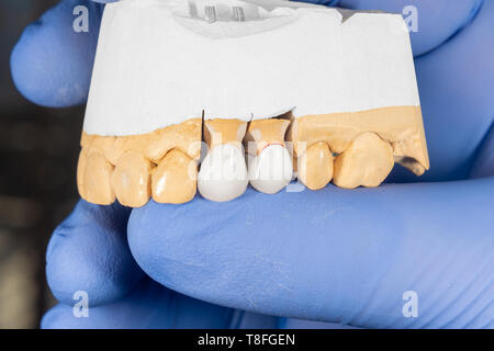 La couronne de la dent céramique close-up sur modèle en plâtre. prothèse dentaire. Banque D'Images