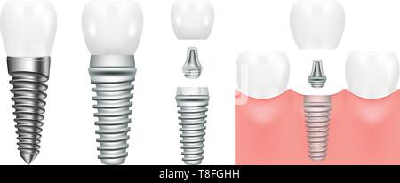 Implant dentaire réaliste avec toutes les pièces de la structure, de l'État, pilier de la vis. La dentisterie. L'implantation de dents humaines. Vector illustration Illustration de Vecteur