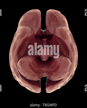 Le rétrécissement de l'atrophie cérébrale ou grave du cerveau causés par la démence et l'Alzheimer Banque D'Images