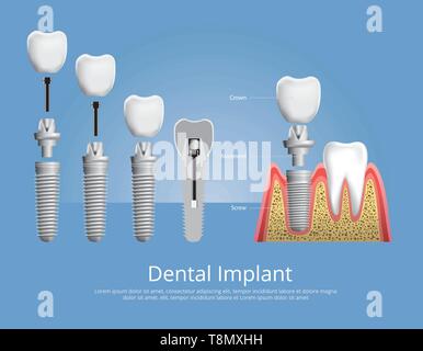 Les dents et les implants dentaires Vector Illustration Illustration de Vecteur