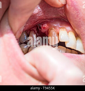 Dent prémolaire supérieure droite vide socket une heure après l'extraction avec saignement, caillot, suture dans la gomme, la coloration des autres dents et gomme l'érosion. Banque D'Images
