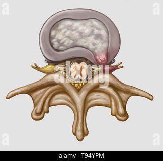 Une illustration de l'hernie d'un disque intervertébral dans la colonne lombaire. Les individus souffrent d'une hernie discale lorsque l'enveloppe de tissu fibreux du disque, connu sous le nom de l'anulus fibrosus, peut se rompre en raison d'un traumatisme ou d'âge. En conséquence, le centre gélatineux du disque dépasse vers l'extérieur et comprime les nerfs dans le dos, l'affaiblissement des muscles et causant de graves maux de dos locale. Banque D'Images