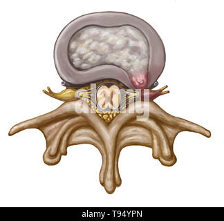 Une illustration de l'hernie d'un disque intervertébral dans la colonne lombaire. Les individus souffrent d'une hernie discale lorsque l'enveloppe de tissu fibreux du disque, connu sous le nom de l'anulus fibrosus, peut se rompre en raison d'un traumatisme ou d'âge. En conséquence, le centre gélatineux du disque dépasse vers l'extérieur et comprime les nerfs dans le dos, l'affaiblissement des muscles et causant de graves maux de dos locale. Banque D'Images