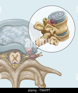 Une illustration de l'hernie d'un disque intervertébral dans la colonne lombaire. Les individus souffrent d'une hernie discale lorsque l'enveloppe de tissu fibreux du disque, connu sous le nom de l'anulus fibrosus, peut se rompre en raison d'un traumatisme ou d'âge. En conséquence, le centre gélatineux du disque dépasse vers l'extérieur et comprime les nerfs dans le dos, l'affaiblissement des muscles et causant de graves maux de dos locale. Banque D'Images