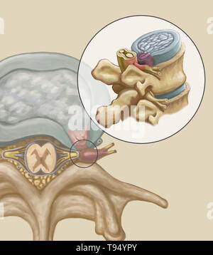 Une illustration de l'hernie d'un disque intervertébral dans la colonne lombaire. Les individus souffrent d'une hernie discale lorsque l'enveloppe de tissu fibreux du disque, connu sous le nom de l'anulus fibrosus, peut se rompre en raison d'un traumatisme ou d'âge. En conséquence, le centre gélatineux du disque dépasse vers l'extérieur et comprime les nerfs dans le dos, l'affaiblissement des muscles et causant de graves maux de dos locale. Banque D'Images