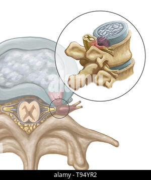 Une illustration de l'hernie d'un disque intervertébral dans la colonne lombaire. Les individus souffrent d'une hernie discale lorsque l'enveloppe de tissu fibreux du disque, connu sous le nom de l'anulus fibrosus, peut se rompre en raison d'un traumatisme ou d'âge. En conséquence, le centre gélatineux du disque dépasse vers l'extérieur et comprime les nerfs dans le dos, l'affaiblissement des muscles et causant de graves maux de dos locale. Banque D'Images