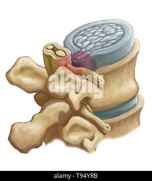 Une illustration de l'hernie d'un disque intervertébral dans la colonne lombaire. Les individus souffrent d'une hernie discale lorsque l'enveloppe de tissu fibreux du disque, connu sous le nom de l'anulus fibrosus, peut se rompre en raison d'un traumatisme ou d'âge. En conséquence, le centre gélatineux du disque dépasse vers l'extérieur et comprime les nerfs dans le dos, l'affaiblissement des muscles et causant de graves maux de dos locale. Banque D'Images